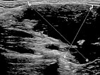 Sonography: venous malformation