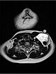 MRI: hypointense thrombus