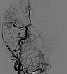 DSA: anterior-posterior view, after injection into the right common carotid artery