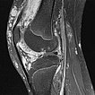 MRI: venous malformation in the knee