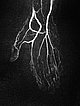 MR angiography: venous malformation