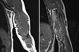 MRI – Infantile hemangioma