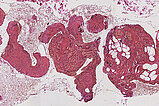 Histopathology EvG stain – Intramuscular venous malformation