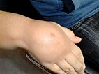 Swelling on the dorsum of the right hand