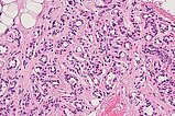 Histopathology H&E stain – Subcutaneous infantile hemangioma