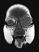 MRI: infantile hemangioma on the eyelid