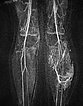 MR angiography: venous malformation