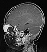 MRI: infantile hemangioma on the eyelid