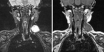 MRI: venous malformation