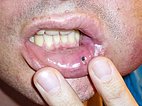 Small mucosal wound occurred on the lower lip
