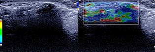 Ultrasound elastography: connective tissue nevus