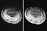 MRI – characteristic thickening of the cutis
