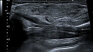 Sonography – Subcutaneous infantile hemangioma