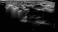 Sonography during sclerotherapy treatment