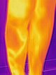 Infrared thermography: no more heating in the area of the knee