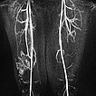 MR angiography: slow pooling of the contrast agent