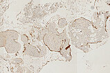 Histopathology CD31 stain – Intramuscular venous malformation
