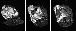 MRI: lymphatic malformation