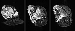 MRI: lymphatic malformation