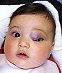 Infantile hemangioma on the upper eyelid