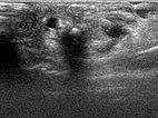 Embolization: arteriovenous malformation