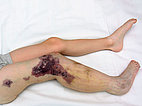 Lymphedema remains mild