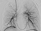 Digital subtraction angiography: complete occlusion of the pulmonary AVMs