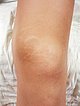 patient with recurrent painful swelling at the medial distal left thigh