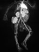 MR angiography – Kaposiform hemangioendothelioma
