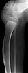 Knee joint contracture in progressive PTEN hamartoma