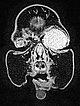 MRI: infantile hemangioma on the eyelid