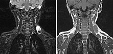 MRI: thrombus within the venous malformation