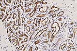 Histopathology GLUT1 staining – Subcutaneous infantile hemangioma