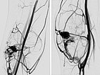 Digital subtraction angiography: PTEN hamartoma