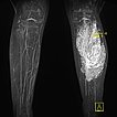 MR angiography: venous malformation