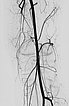 DSA: after embolization