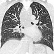 Computed tomography – Upper airway obstruction