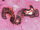 Histopathology H&E stain – Arteriovenous malformation of neck/chest
