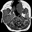 MRI: infantile hemangioma
