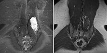 MRI  – Intramuscular venous malformation