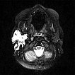 MRI: lymphatic malformation of the parotid gland