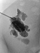 X-ray: lymphatic malformation