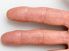 Osler spots on the finger