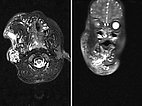 MRI: lymphatic malformation of the face