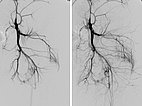 Digital subtraction angiography: Parkes-Weber syndrome.