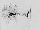 DSA: microcatheter is advanced to just before the nidus