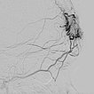 DSA: microcatheter was advanced directly into the nidus