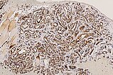 Histopathology WT1 staining – Subcutaneous infantile hemangioma