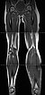 MRI: Parkes-Weber syndrome