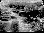 Sonography: venous malformation